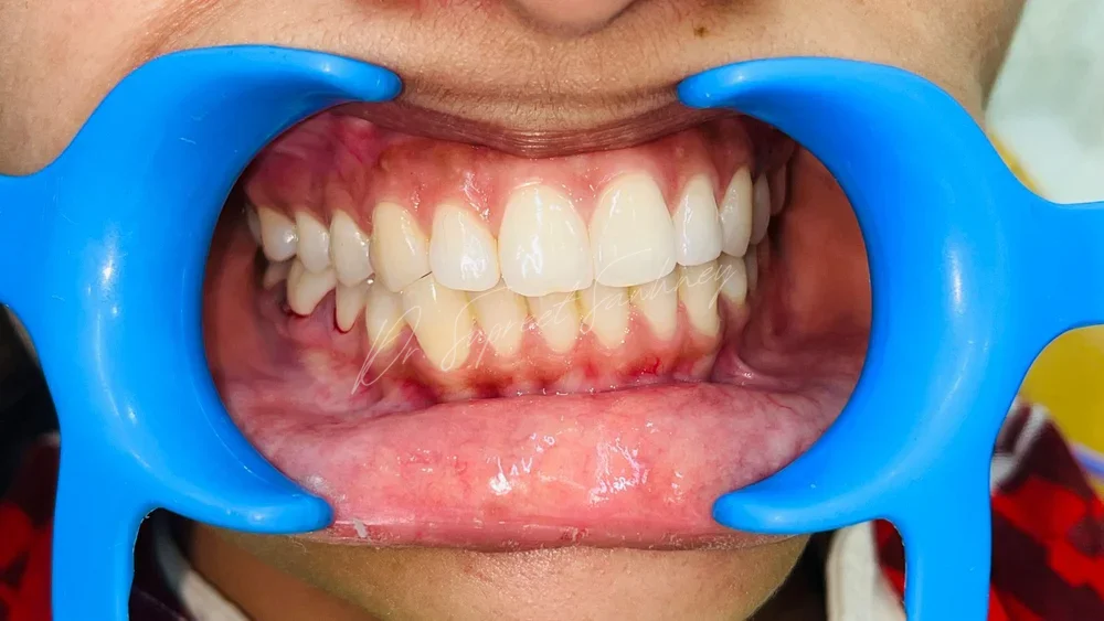 Frontal retracted intraoral photograph before posterior mandibular implant treatment